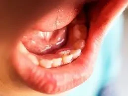 ظهور سن في اللثه image