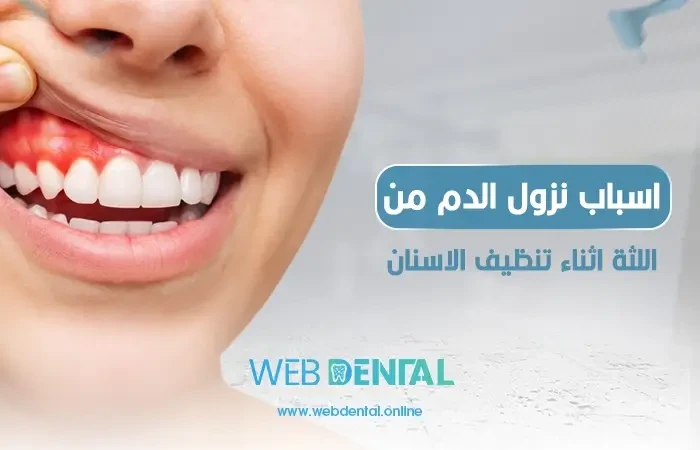 اسباب نزول الدم من اللثة اثناء تنظيف الاسنان image