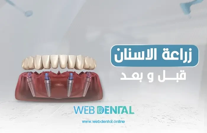 زراعة الاسنان قبل وبعد image