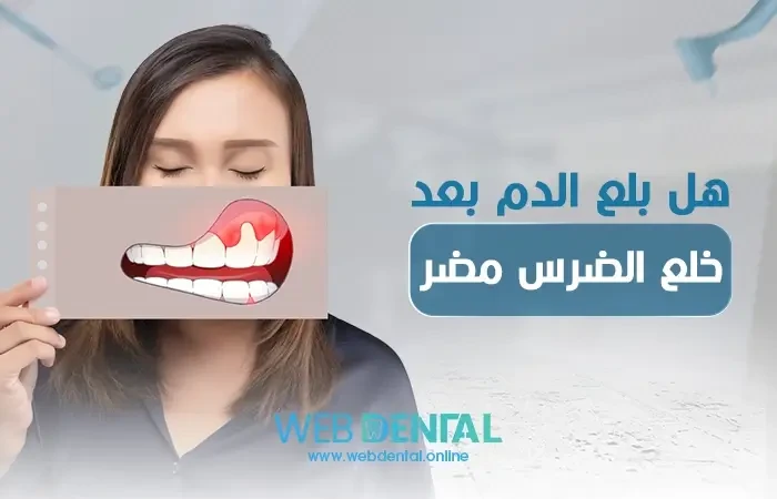 هل بلع الدم بعد خلع الضرس مضر؟ اعرف الجواب image