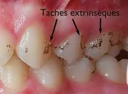 ظهور خطوط سوداء على الاسنان image