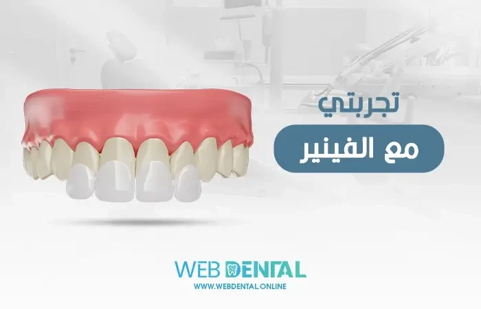 تجربتي مع الفينير image