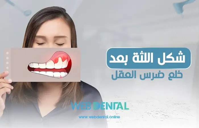 شكل اللثة بعد خلع ضرس العقل image
