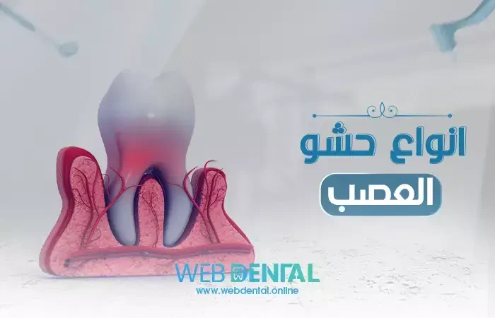 انواع الحشو العصب image