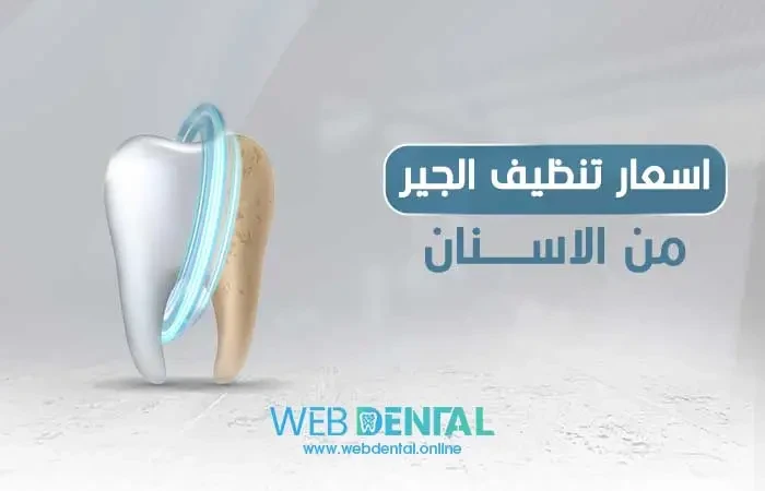 اسعار تنظيف الجير من الاسنان image