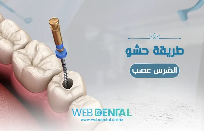 طريقة حشو الضرس عصب image